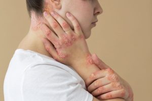 Fungal Infections